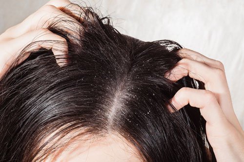Tipps zur Haarpflege bei Schuppen