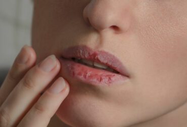 Im Winter müssen die Lippen besonders gepflegt werden.