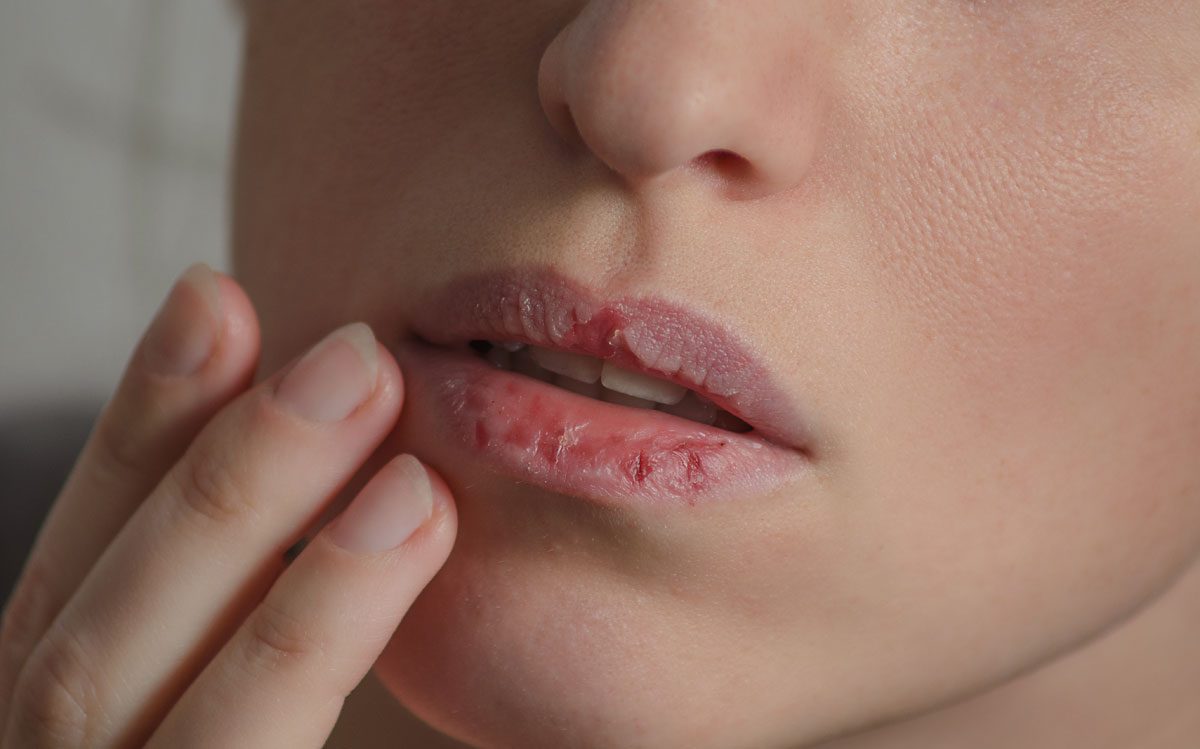 spröde Lippen Im Winter müssen die Lippen besonders gepflegt werden.