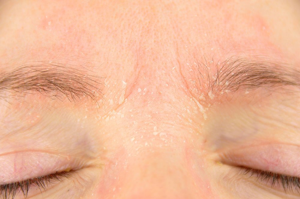 Schuppige Augenbrauen Ursache Und Tipps Zur Behandlung Beauty Tipps Net