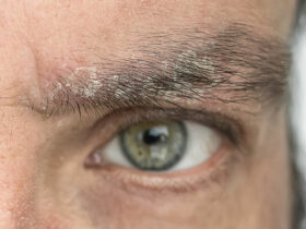 Mann mit schuppigen Augenbrauen
