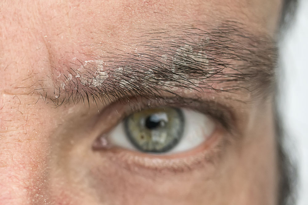 Mann mit schuppigen Augenbrauen