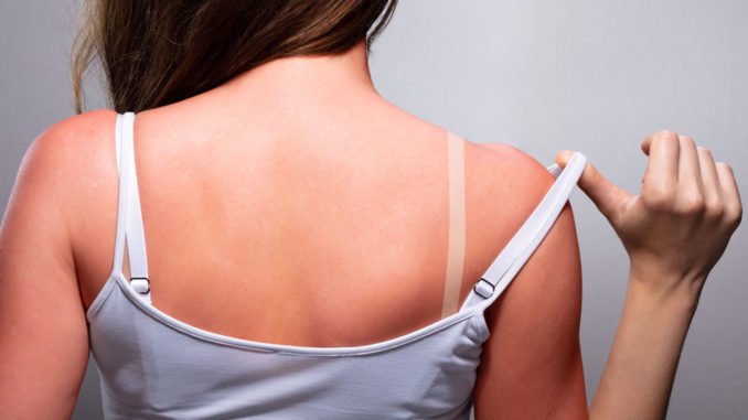 Hausmittel und Tipps bei Sonnenbrand