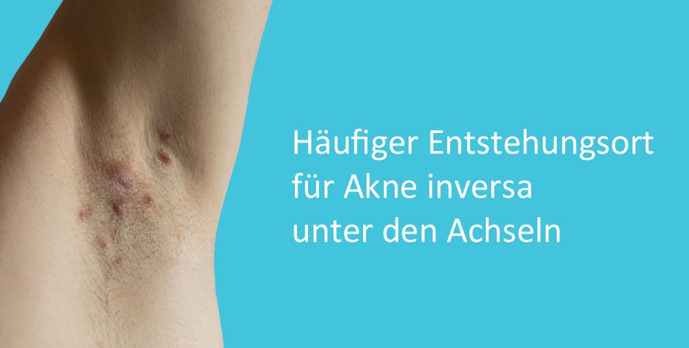 Akne inversa unter den Achseln