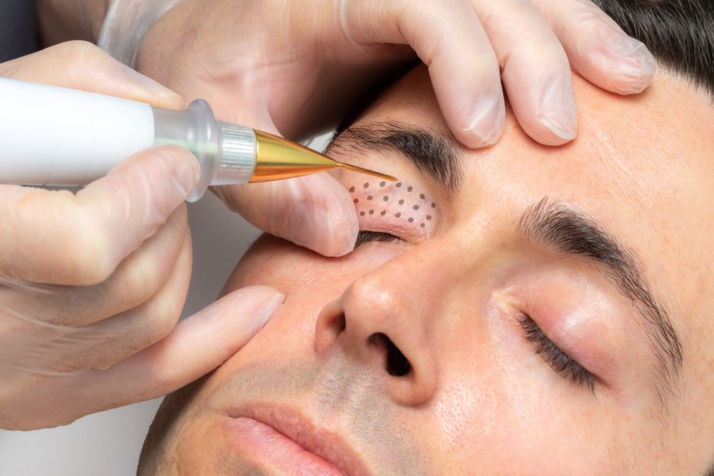 Behandlung eines Mannes mit dem Plasma-Pen Lidstraffung mittels Plasma-Pen