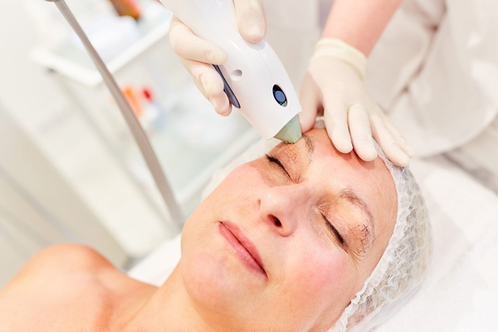 Thermage-Lidstraffung Lidstraffung mittels Thermage