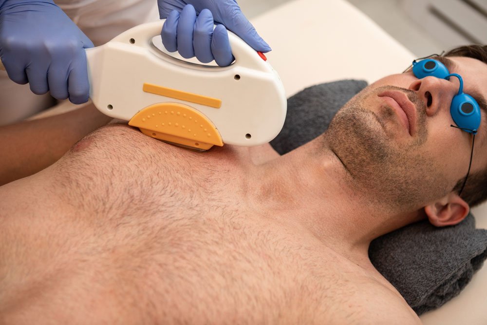IPL und SHR entfernen die Haare per Licht IPL-Behandlung bei einer Männerbrust