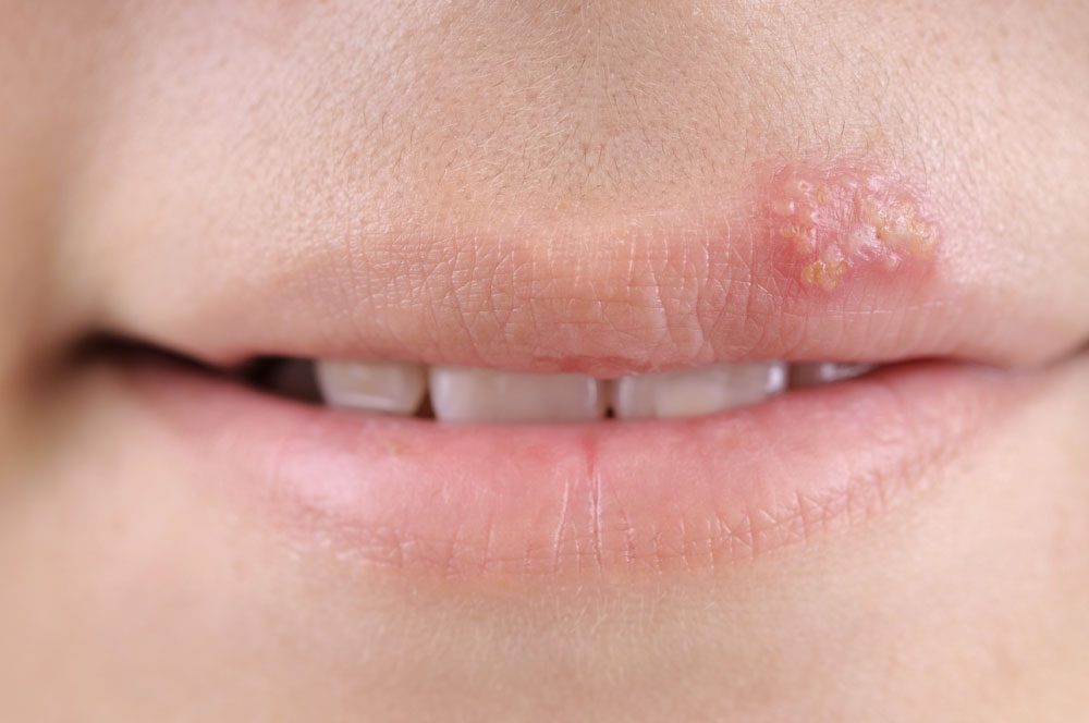 Herpes an der Oberlippe Herpes