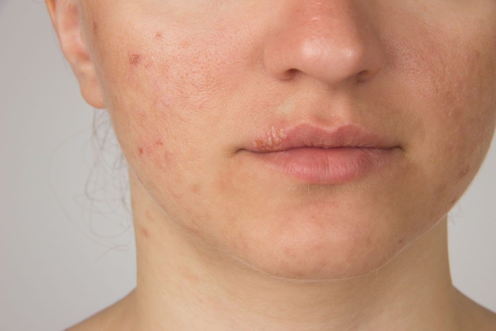 Frau mit Pickel und Herpes an der Oberlippe Pickel und Herpes