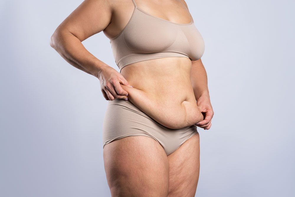 Frau in Unterwäsche hält überschüssige Haut am Bauch in den Händen überschüssige Haut
