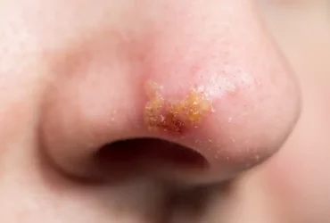 Herpes an der Nase